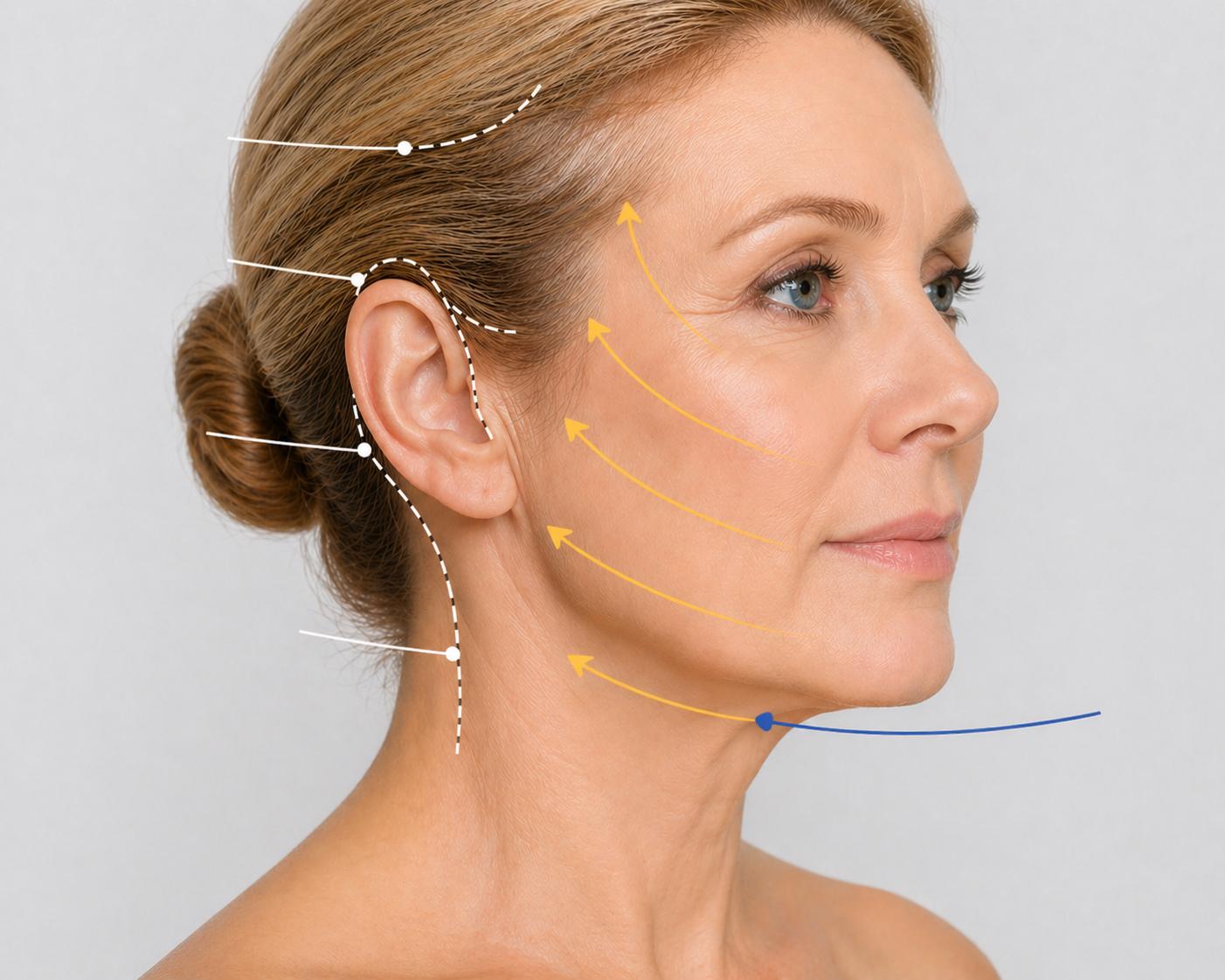 Deep Plane Facelifting