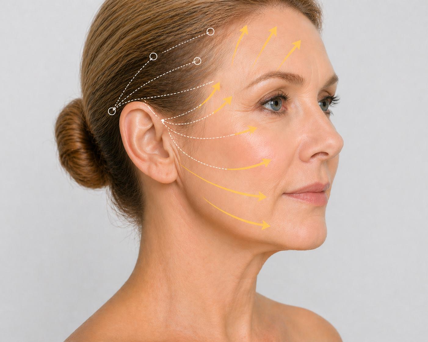 Endoskopisches Facelifting