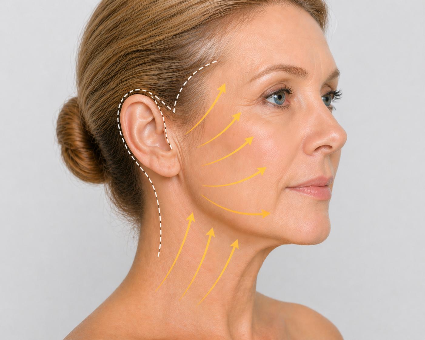 Traditionelles Facelifting